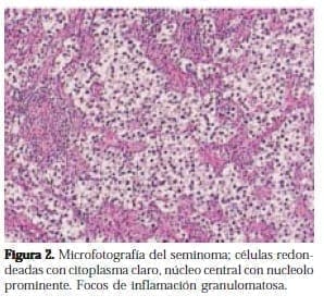 Microfotografía del Seminoma