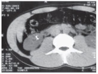 Migración de la Aguja hasta el Parénquima Renal Migración de la Aguja hasta el Parénquima Renal