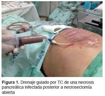Drenaje Guiado por TC de una Necrosis Pancreática Infectada Drenaje Guiado por TC de una Necrosis Pancreática Infectada