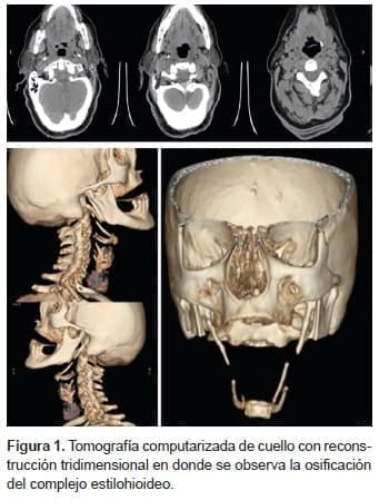 Osificación del complejo Estilohioideo Osificación del complejo Estilohioideo