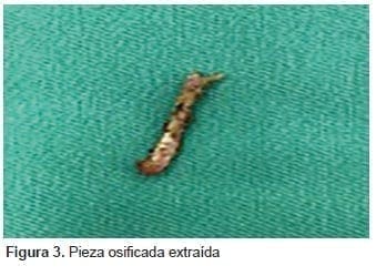 Pieza osificada extraída Pieza osificada extraída
