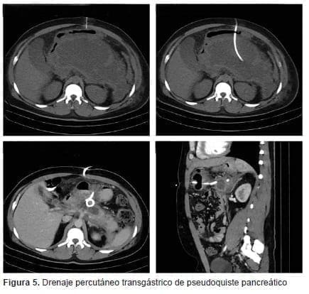 Drenaje Percutáneo Transgástrico de Pseudoquiste Pancreático Drenaje Percutáneo Transgástrico de Pseudoquiste Pancreático