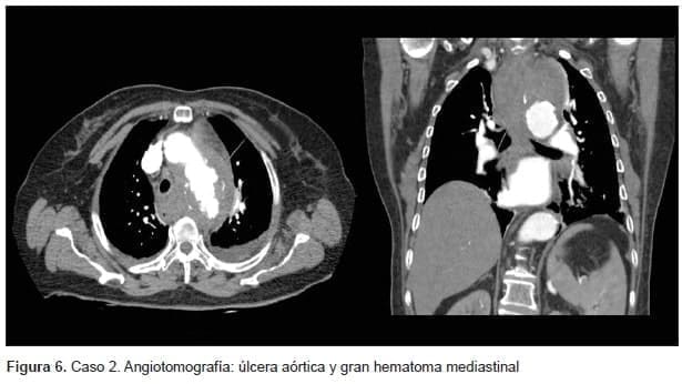 Úlcera Aórtica y gran Hematoma Mediastinal Úlcera Aórtica y gran Hematoma Mediastinal
