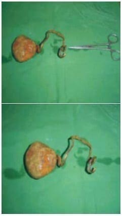 Uretero-Hidronefrosis izquierda Uretero-Hidronefrosis izquierda