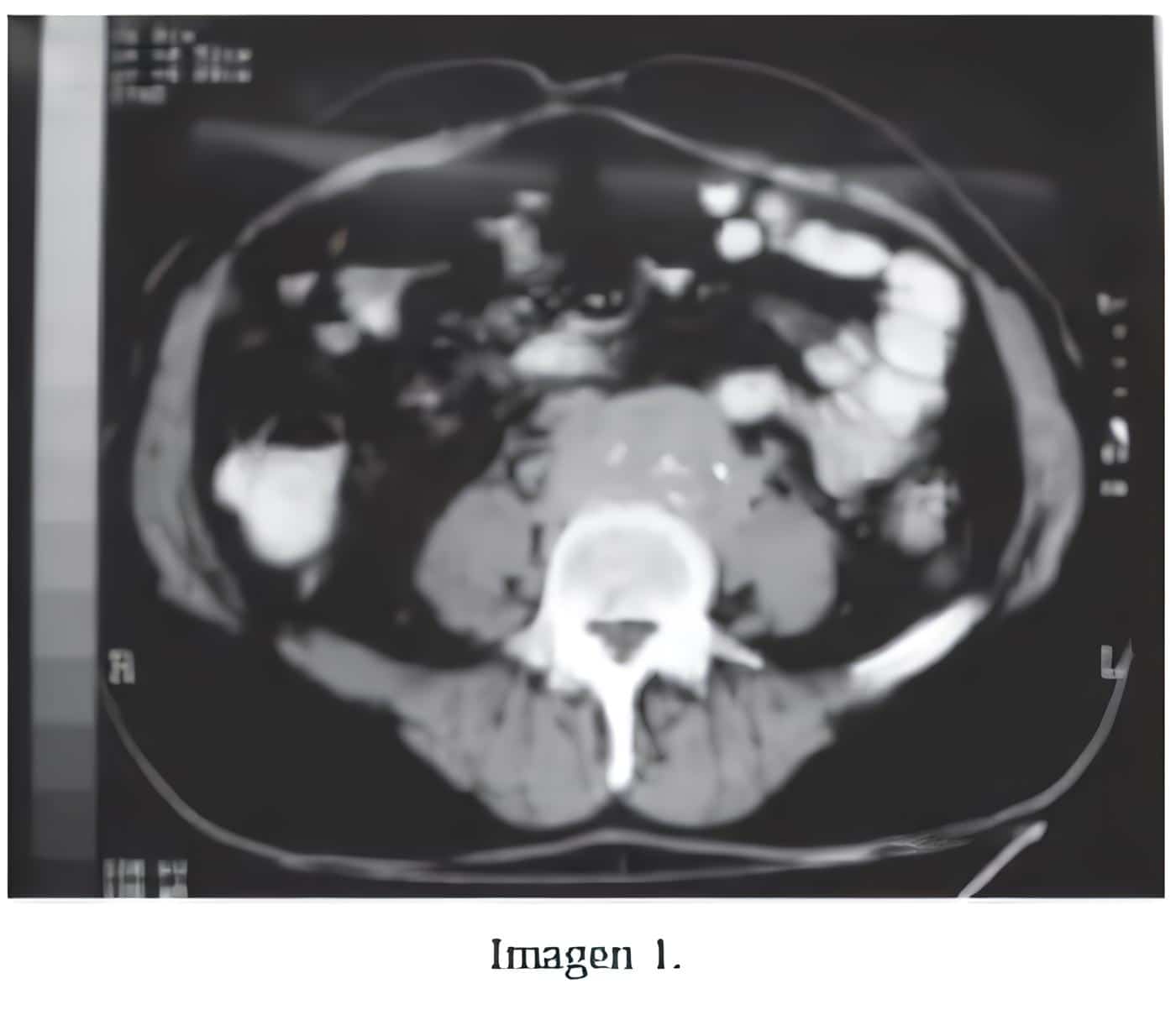 Fibrosis Retroperitoneal