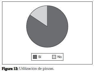 Ureterolitotomía Endoscopica, Utliización de pinzas Ureterolitotomía Endoscopica, Utliización de pinzas