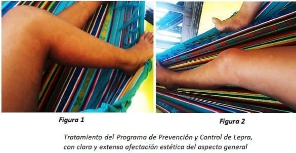Tratamiento del Programa de Prevención y Control de Lepra Tratamiento del Programa de Prevención y Control de Lepra