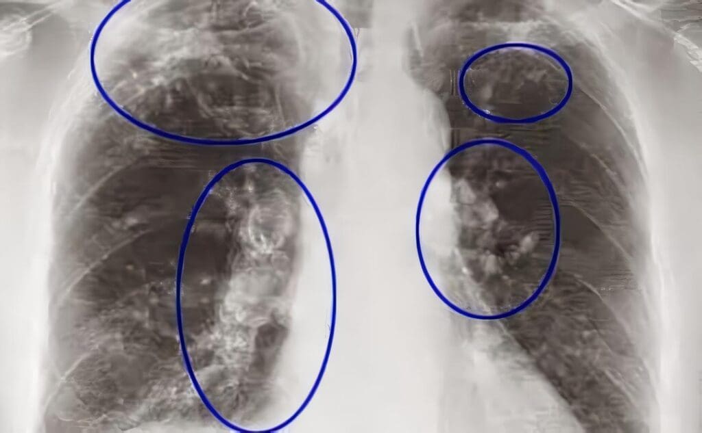Neumoconiosis