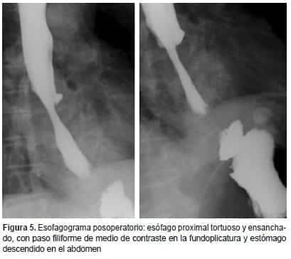 Esofagograma posoperatorio