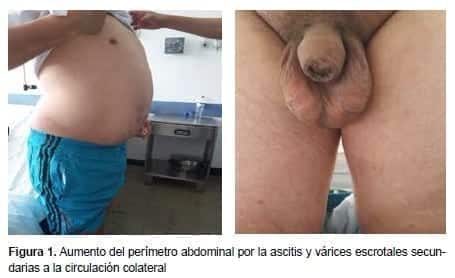 Síndrome de Budd-Chiari, várices escrotales