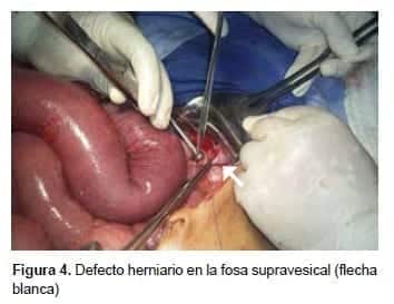 Defecto herniario en la fosa supravesical