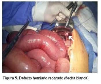Defecto herniario reparado