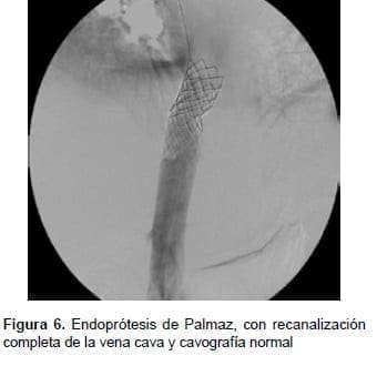 Endoprótesis de Palmaz