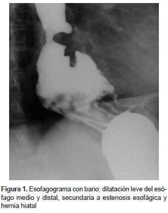 Esofagograma con bario