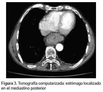 Estómago localizado en el mediastino posterior