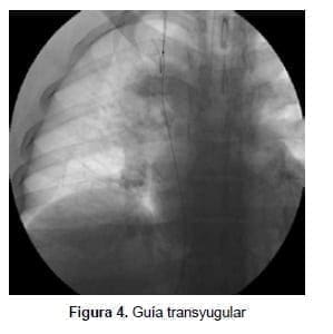 Guía transyugular, Síndrome de Budd-Chiari