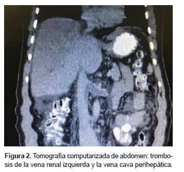 Trombosis de la vena renal izquierda y la vena cava perihepática