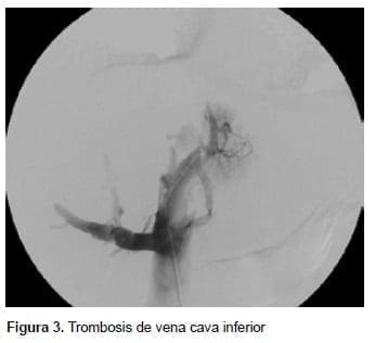Trombosis de vena cava inferior