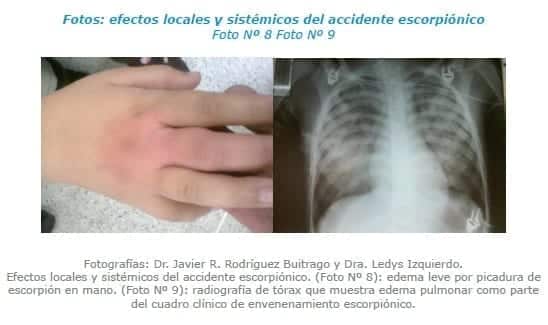 Efectos locales y sistémicos del accidente escorpiónico