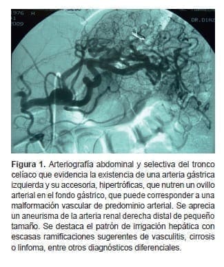 Arteriografía abdominal y selectiva del tronco celíaco Arteriografía abdominal y selectiva del tronco celíaco