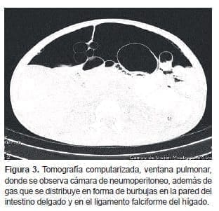 Cámara de neumoperitoneo Cámara de neumoperitoneo