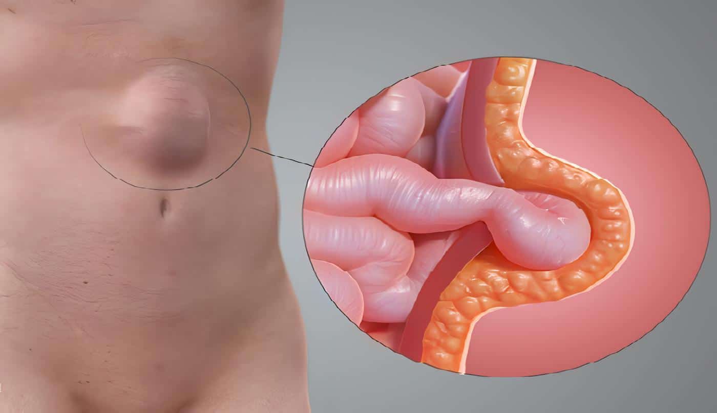 Hernia Ventral