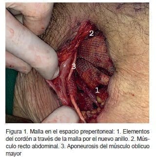 Malla en el espacio preperitoneal Malla en el espacio preperitoneal