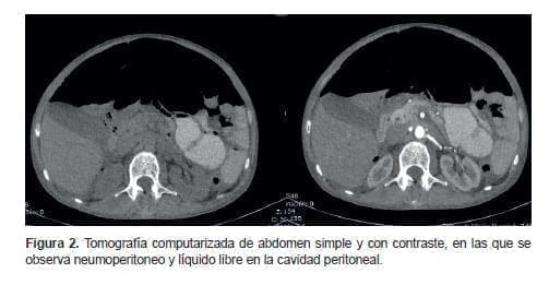 Neumoperitoneo y líquido libre en la cavidad peritoneal Neumoperitoneo y líquido libre en la cavidad peritoneal