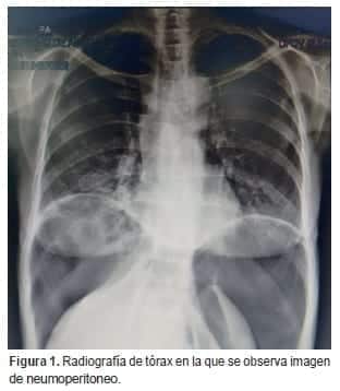 Radiografía de tórax en la que se observa imagen de neumoperitoneo Radiografía de tórax en la que se observa imagen de neumoperitoneo