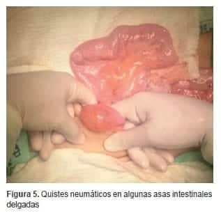 Quistes neumáticos en algunas asas intestinales delgadas Quistes neumáticos en algunas asas intestinales delgadas