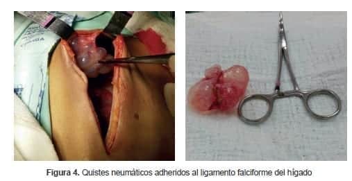 Quistes neumáticos adheridos al ligamento falciforme del hígado Quistes neumáticos adheridos al ligamento falciforme del hígado