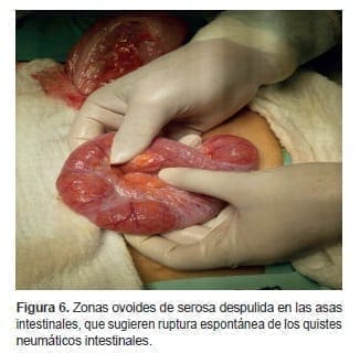 Zonas ovoides de serosa despulida en las asas intestinales Zonas ovoides de serosa despulida en las asas intestinales
