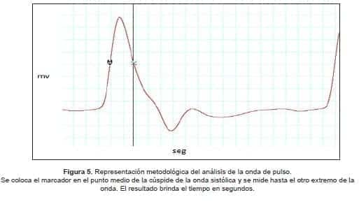 Representación metodológica del análisis de la onda de pulso Representación metodológica del análisis de la onda de pulso