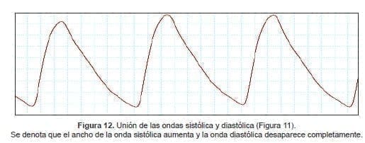 Se denota que el ancho de la onda sistólica aumenta y la onda diastólica desaparece completamente Se denota que el ancho de la onda sistólica aumenta y la onda diastólica desaparece completamente