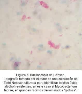 Baciloscopia de Hansen. Baciloscopia de Hansen.
