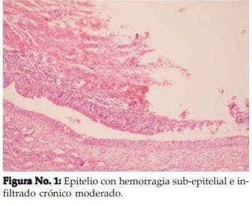 Epitelio con hemorragia sub-epitelial e infiltrado crónico moderado Epitelio con hemorragia sub-epitelial e infiltrado crónico moderado