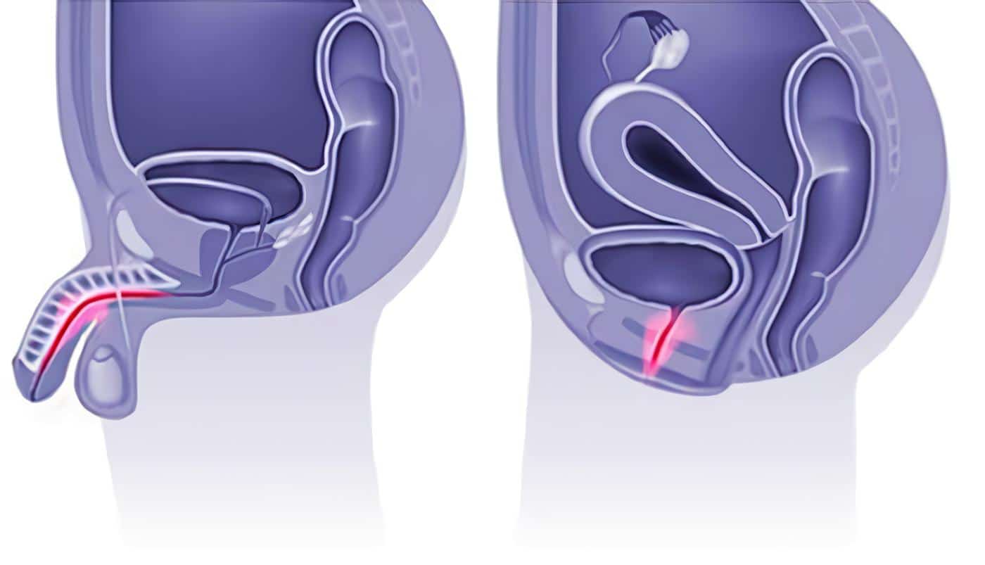 Obstrucción Ureteral