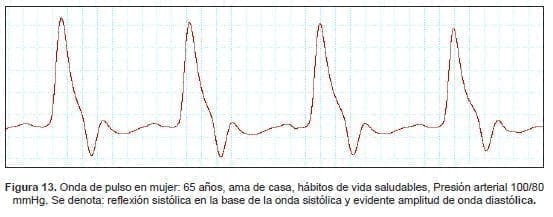 Onda de pulso en mujer: 65 años, ama de casa Onda de pulso en mujer: 65 años, ama de casa