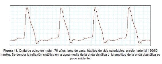 Onda de pulso en mujer: 76 años, ama de casa, Onda de pulso en mujer: 76 años, ama de casa