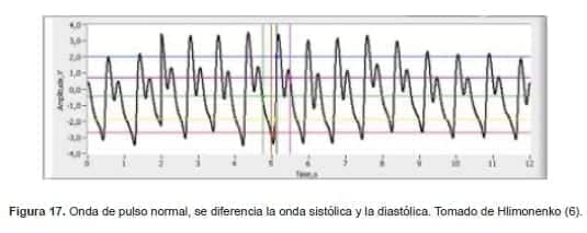 Onda de pulso normal, se diferencia la onda sistólica y la diastólica Onda de pulso normal, se diferencia la onda sistólica y la diastólica