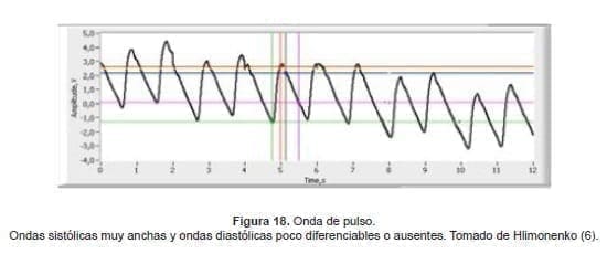 Ondas sistólicas muy anchas y ondas diastólicas poco diferenciables o ausentes Ondas sistólicas muy anchas y ondas diastólicas poco diferenciables o ausentes