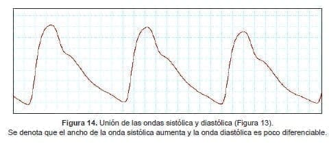 Se denota que el ancho de la onda sistólica aumenta y la onda diastólica es poco diferenciable Se denota que el ancho de la onda sistólica aumenta y la onda diastólica es poco diferenciable