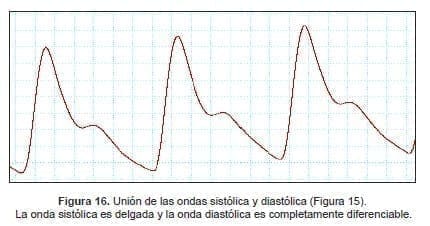 La onda sistólica es delgada y la onda diastólica es completamente diferenciable La onda sistólica es delgada y la onda diastólica es completamente diferenciable