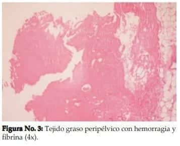 Tejido graso peripélvico con hemorragia y fibrina (4x)  Tejido graso peripélvico con hemorragia y fibrina (4x)