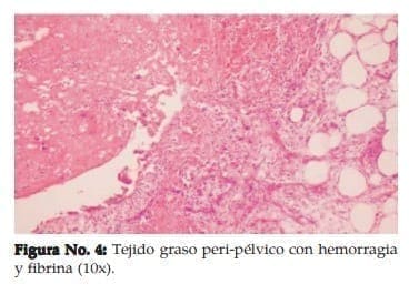 Tejido graso peri-pélvico con hemorragia y fibrina (10x). Tejido graso peri-pélvico con hemorragia y fibrina (10x).