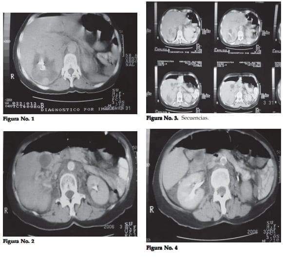 Tumor Maligno (Hipernefroma)  Tumor Maligno (Hipernefroma)