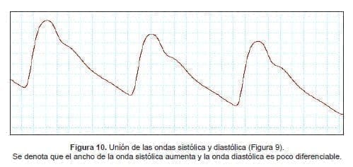 Unión de las ondas sistólica y diastólica Unión de las ondas sistólica y diastólica