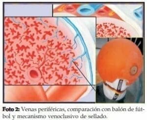 Venas periféricas, comparación con balón de fútbol  Venas periféricas, comparación con balón de fútbol