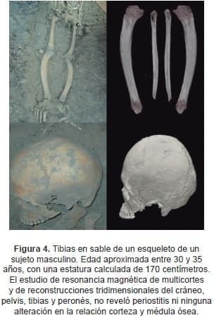 Severidad de las tibias en sable Severidad de las tibias en sable