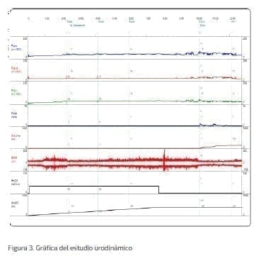 Gráfica del estudio urodinámico Gráfica del estudio urodinámico